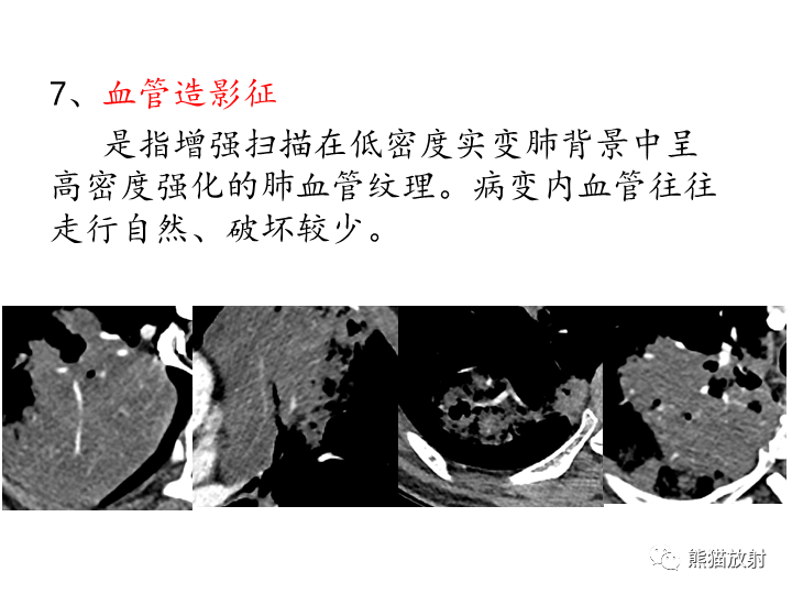 影像PPT - 【病例】肺粘液腺癌2例CT影像-33
