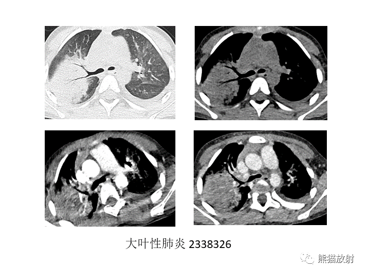 影像PPT - 【病例】肺粘液腺癌2例CT影像-35