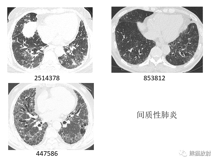 影像PPT - 【病例】肺粘液腺癌2例CT影像-37