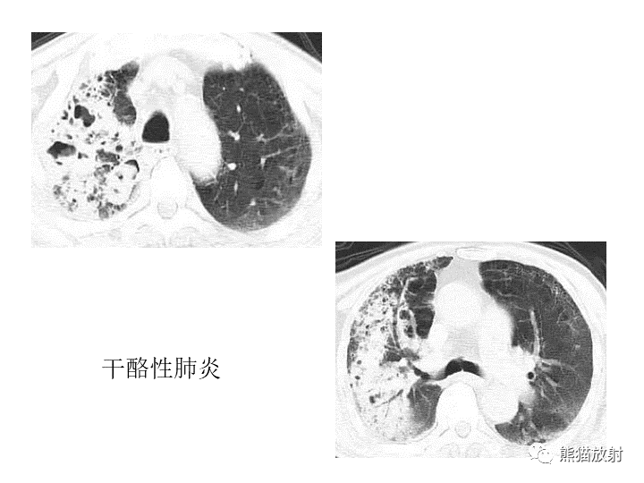 影像PPT - 【病例】肺粘液腺癌2例CT影像-39