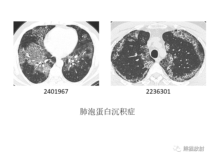 影像PPT - 【病例】肺粘液腺癌2例CT影像-41