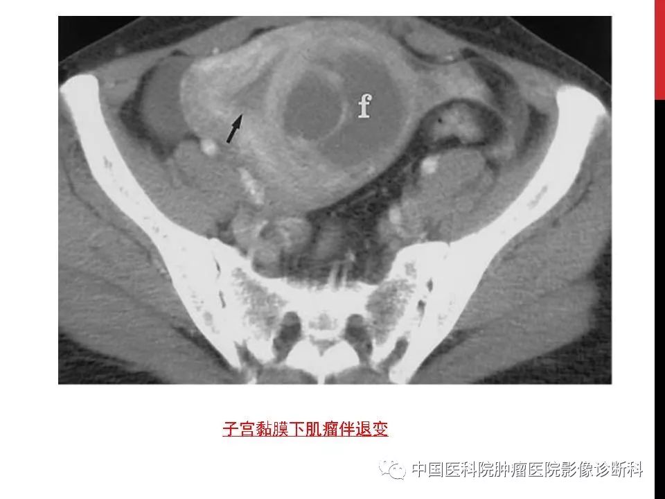影像PPT - 【PPT】妇产科急腹症的影像诊断-5 影像PPT - 【PPT】妇产科急腹症的影像诊断-5