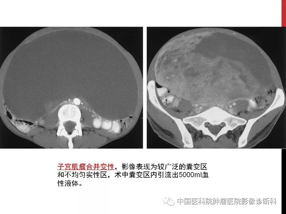 影像PPT - 【PPT】妇产科急腹症的影像诊断-6 影像PPT - 【PPT】妇产科急腹症的影像诊断-6