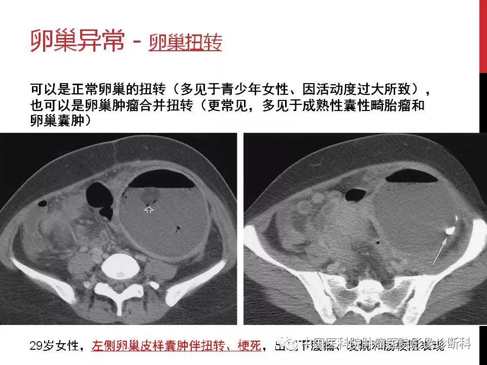 影像PPT - 【PPT】妇产科急腹症的影像诊断-7 影像PPT - 【PPT】妇产科急腹症的影像诊断-7
