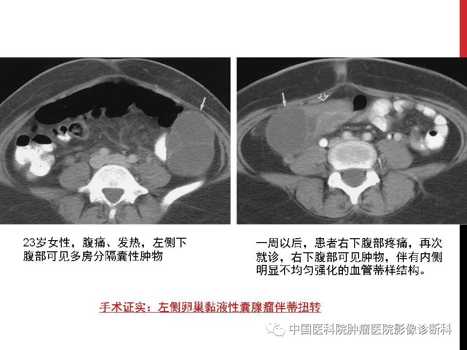 影像PPT - 【PPT】妇产科急腹症的影像诊断-8 影像PPT - 【PPT】妇产科急腹症的影像诊断-8