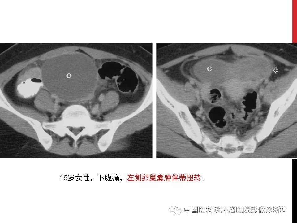 影像PPT - 【PPT】妇产科急腹症的影像诊断-9 影像PPT - 【PPT】妇产科急腹症的影像诊断-9