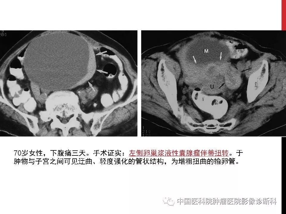影像PPT - 【PPT】妇产科急腹症的影像诊断-10 影像PPT - 【PPT】妇产科急腹症的影像诊断-10