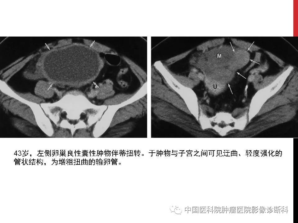 影像PPT - 【PPT】妇产科急腹症的影像诊断-11 影像PPT - 【PPT】妇产科急腹症的影像诊断-11