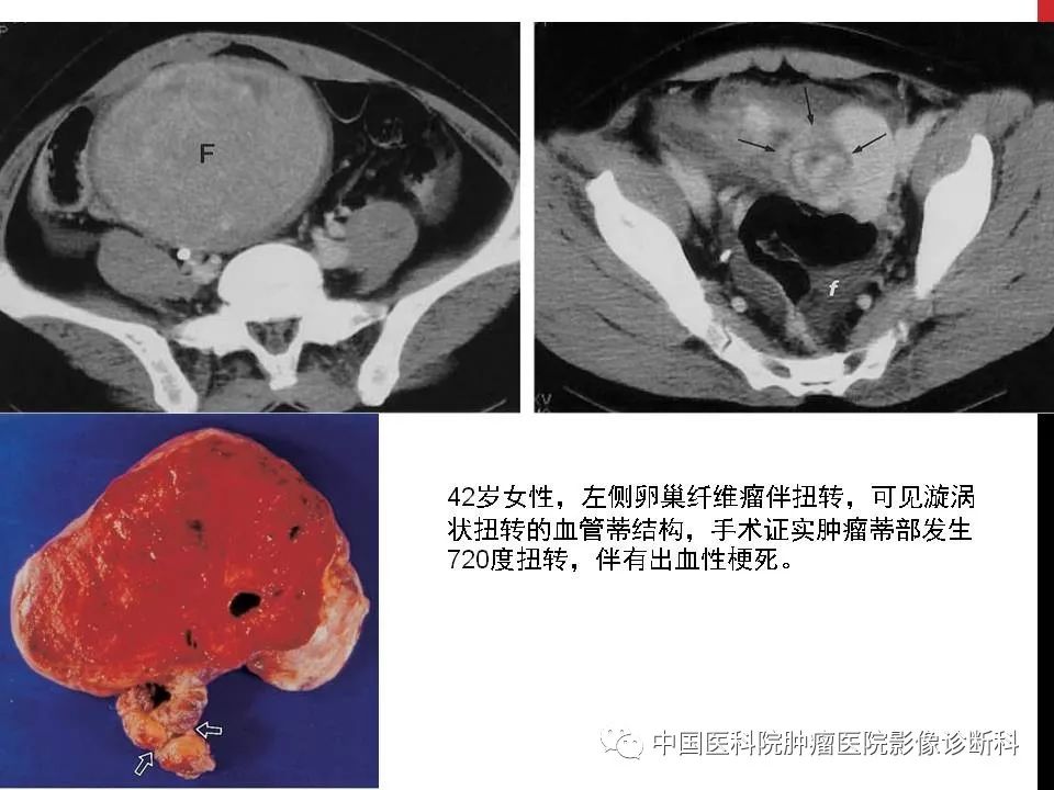 影像PPT - 【PPT】妇产科急腹症的影像诊断-12 影像PPT - 【PPT】妇产科急腹症的影像诊断-12