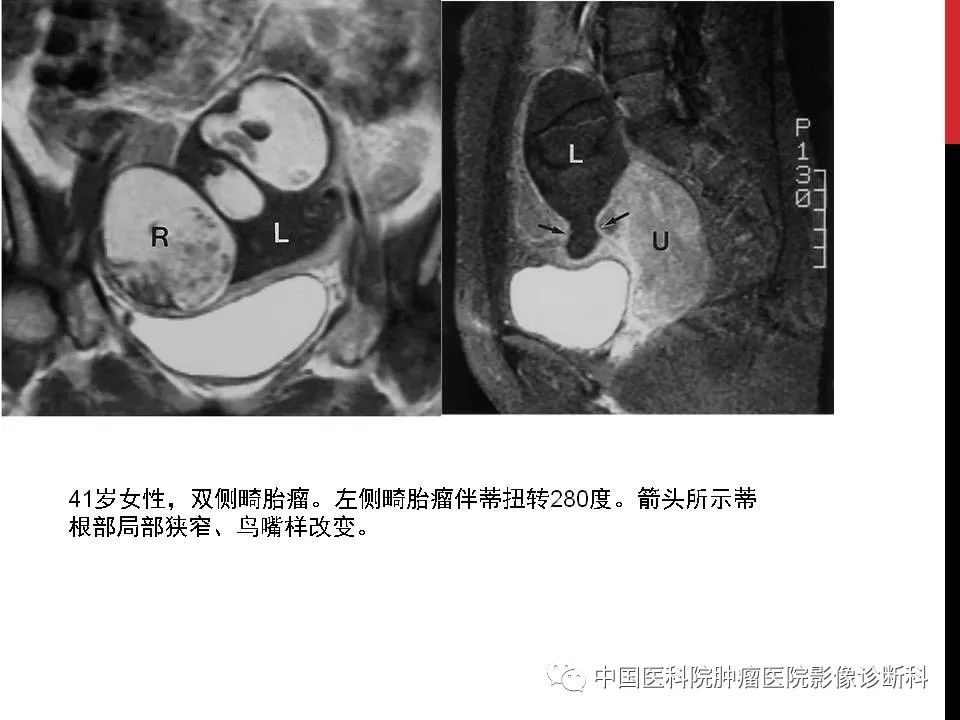 影像PPT - 【PPT】妇产科急腹症的影像诊断-13 影像PPT - 【PPT】妇产科急腹症的影像诊断-13