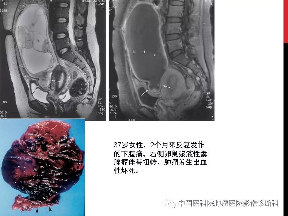 影像PPT - 【PPT】妇产科急腹症的影像诊断-14 影像PPT - 【PPT】妇产科急腹症的影像诊断-14