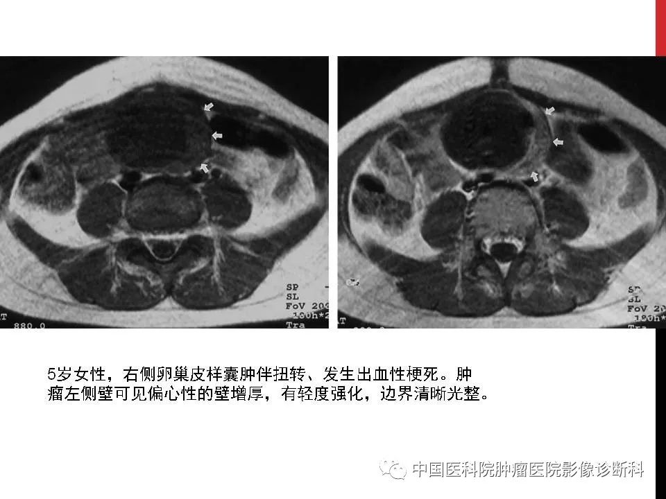 影像PPT - 【PPT】妇产科急腹症的影像诊断-15 影像PPT - 【PPT】妇产科急腹症的影像诊断-15