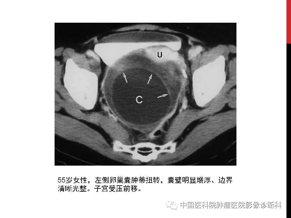 影像PPT - 【PPT】妇产科急腹症的影像诊断-16 影像PPT - 【PPT】妇产科急腹症的影像诊断-16