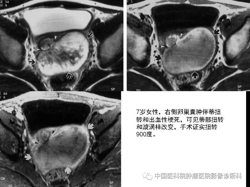 影像PPT - 【PPT】妇产科急腹症的影像诊断-17 影像PPT - 【PPT】妇产科急腹症的影像诊断-17