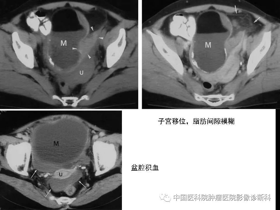 影像PPT - 【PPT】妇产科急腹症的影像诊断-18 影像PPT - 【PPT】妇产科急腹症的影像诊断-18