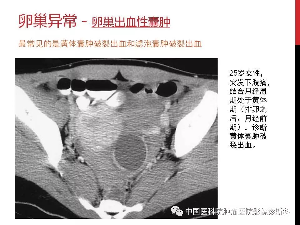 影像PPT - 【PPT】妇产科急腹症的影像诊断-20 影像PPT - 【PPT】妇产科急腹症的影像诊断-20