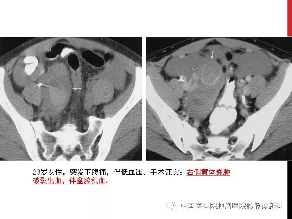 影像PPT - 【PPT】妇产科急腹症的影像诊断-21 影像PPT - 【PPT】妇产科急腹症的影像诊断-21