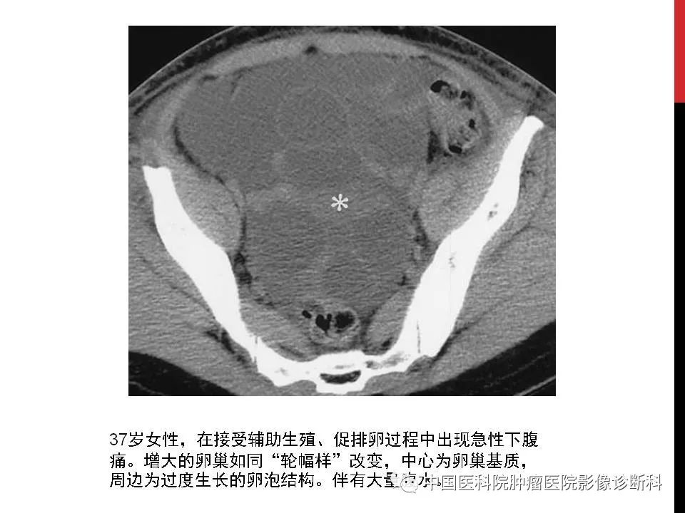 影像PPT - 【PPT】妇产科急腹症的影像诊断-23 影像PPT - 【PPT】妇产科急腹症的影像诊断-23