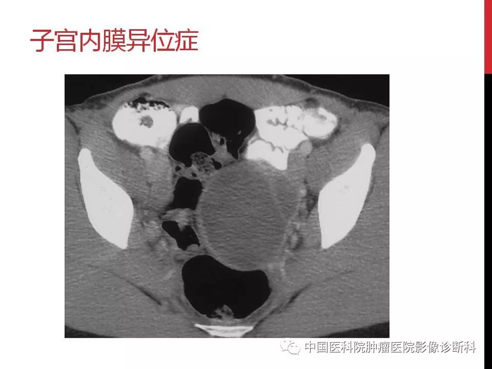 影像PPT - 【PPT】妇产科急腹症的影像诊断-24 影像PPT - 【PPT】妇产科急腹症的影像诊断-24