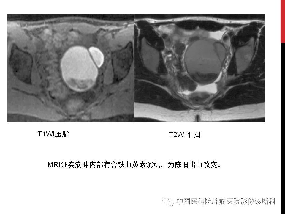 影像PPT - 【PPT】妇产科急腹症的影像诊断-25 影像PPT - 【PPT】妇产科急腹症的影像诊断-25