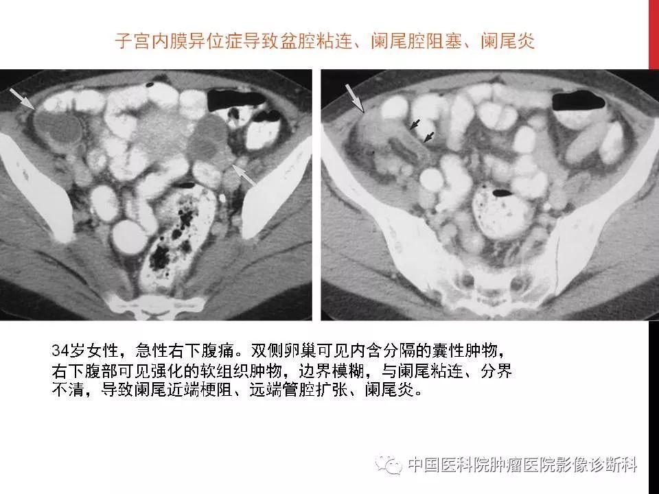 影像PPT - 【PPT】妇产科急腹症的影像诊断-26 影像PPT - 【PPT】妇产科急腹症的影像诊断-26