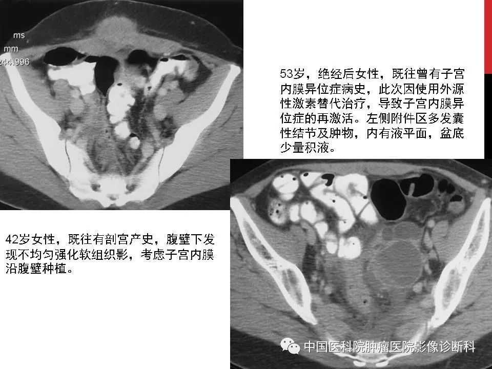 影像PPT - 【PPT】妇产科急腹症的影像诊断-27 影像PPT - 【PPT】妇产科急腹症的影像诊断-27