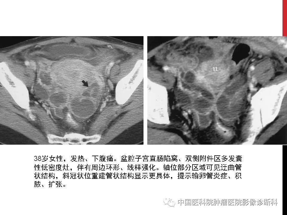 影像PPT - 【PPT】妇产科急腹症的影像诊断-29 影像PPT - 【PPT】妇产科急腹症的影像诊断-29