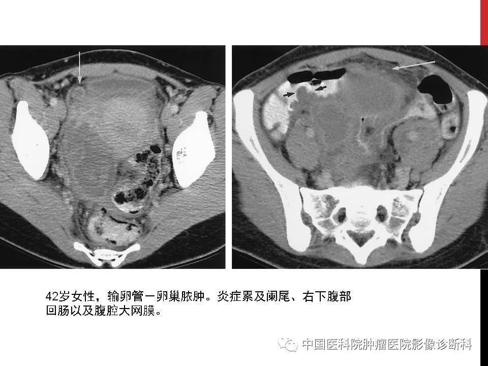 影像PPT - 【PPT】妇产科急腹症的影像诊断-30 影像PPT - 【PPT】妇产科急腹症的影像诊断-30