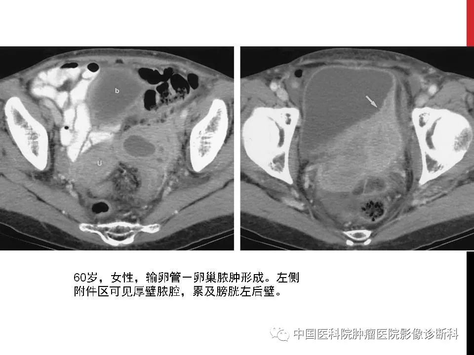 影像PPT - 【PPT】妇产科急腹症的影像诊断-31 影像PPT - 【PPT】妇产科急腹症的影像诊断-31