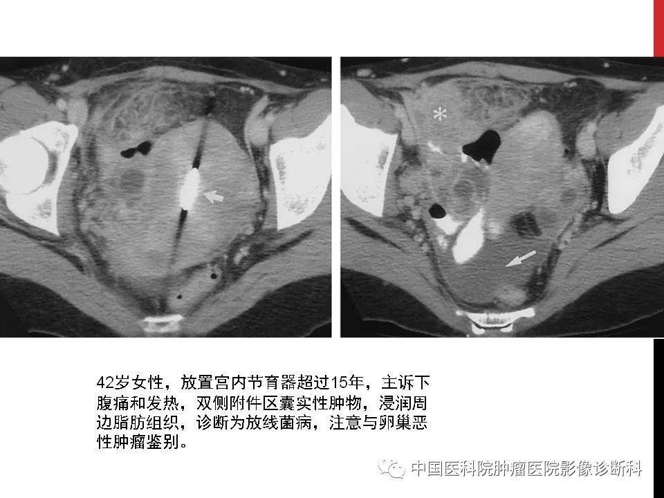 影像PPT - 【PPT】妇产科急腹症的影像诊断-32 影像PPT - 【PPT】妇产科急腹症的影像诊断-32