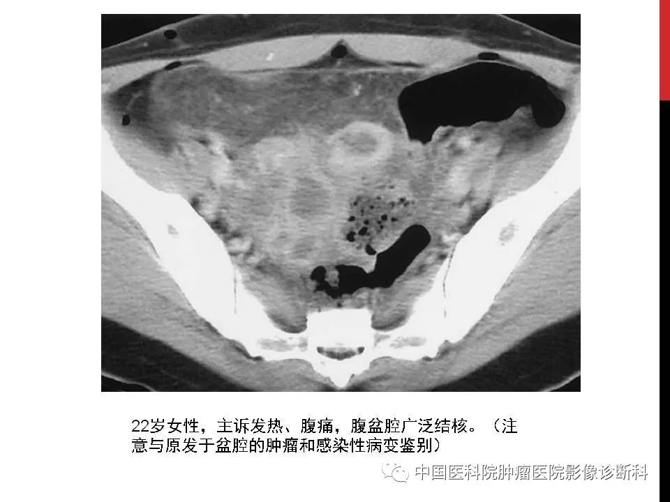 影像PPT - 【PPT】妇产科急腹症的影像诊断-33 影像PPT - 【PPT】妇产科急腹症的影像诊断-33