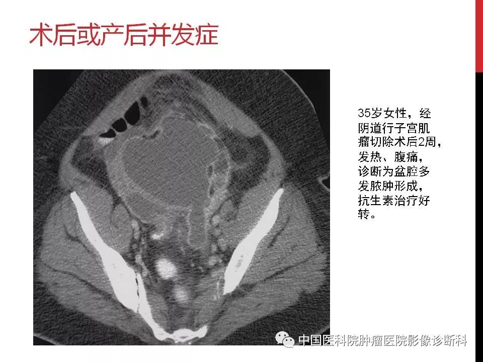 影像PPT - 【PPT】妇产科急腹症的影像诊断-34 影像PPT - 【PPT】妇产科急腹症的影像诊断-34