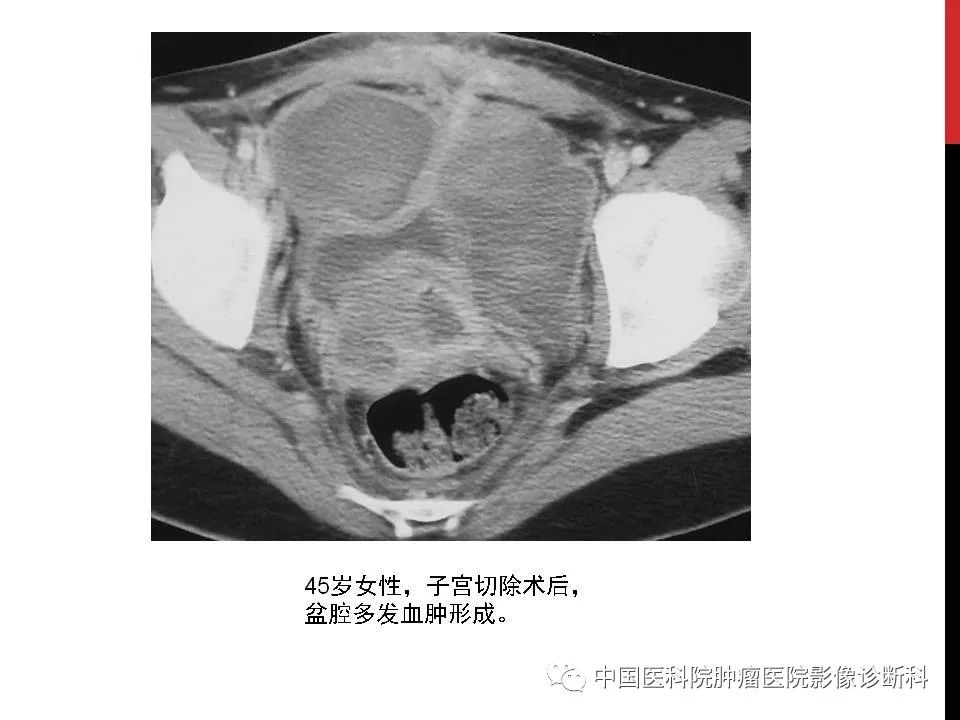 影像PPT - 【PPT】妇产科急腹症的影像诊断-35 影像PPT - 【PPT】妇产科急腹症的影像诊断-35