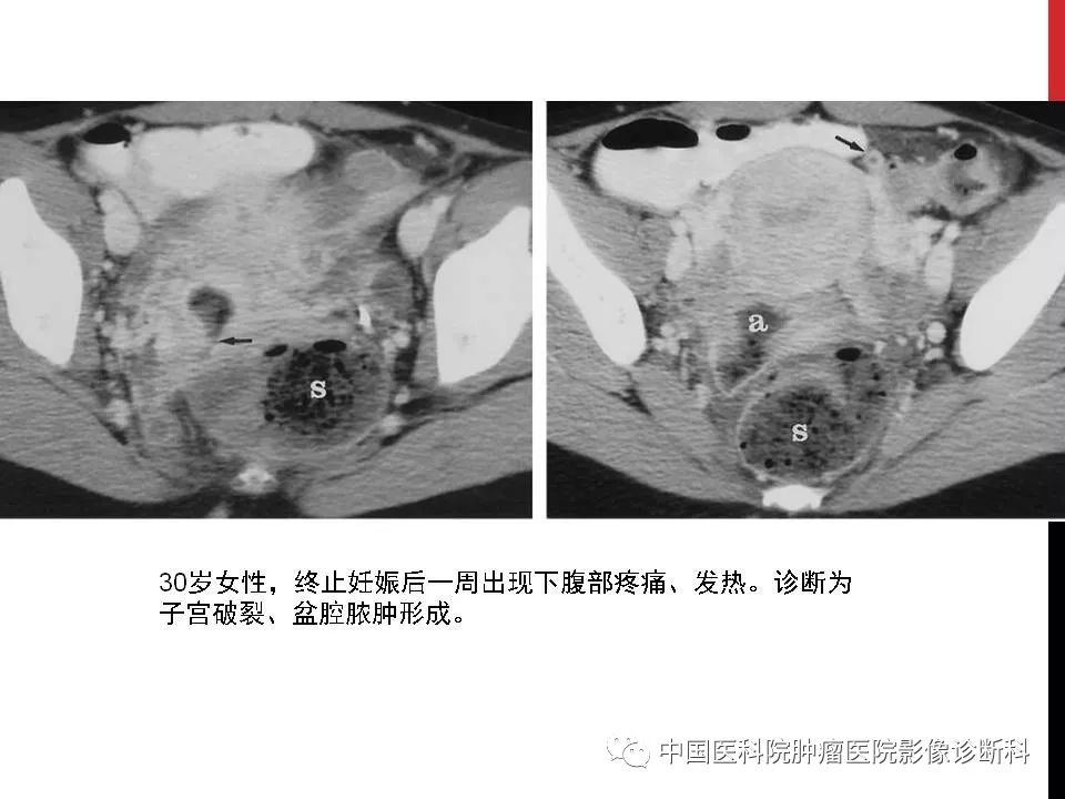 影像PPT - 【PPT】妇产科急腹症的影像诊断-36 影像PPT - 【PPT】妇产科急腹症的影像诊断-36
