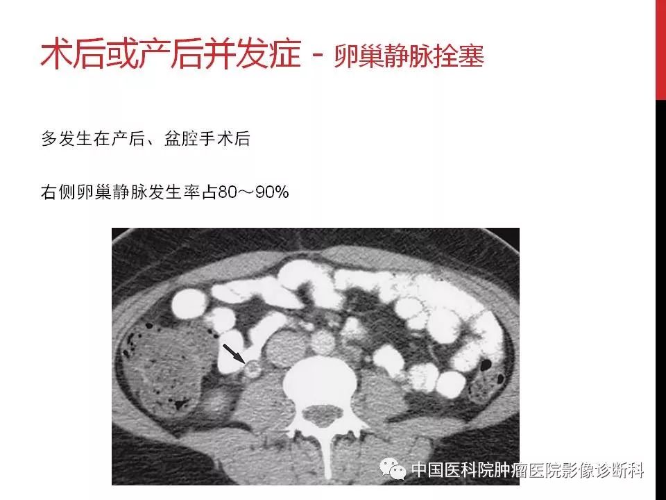 影像PPT - 【PPT】妇产科急腹症的影像诊断-37 影像PPT - 【PPT】妇产科急腹症的影像诊断-37