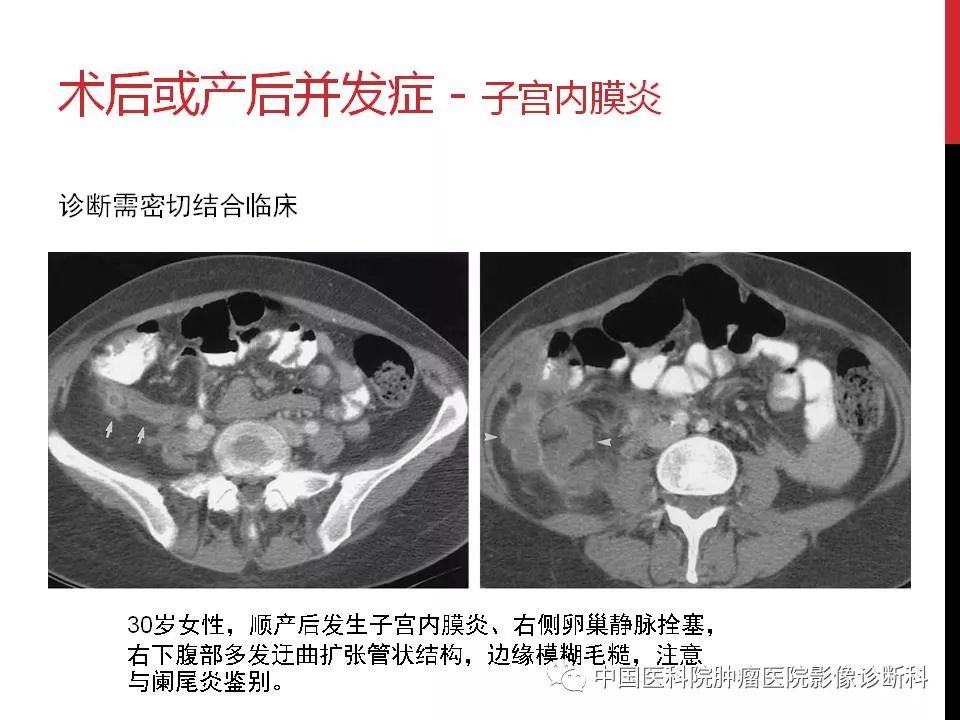 影像PPT - 【PPT】妇产科急腹症的影像诊断-38 影像PPT - 【PPT】妇产科急腹症的影像诊断-38