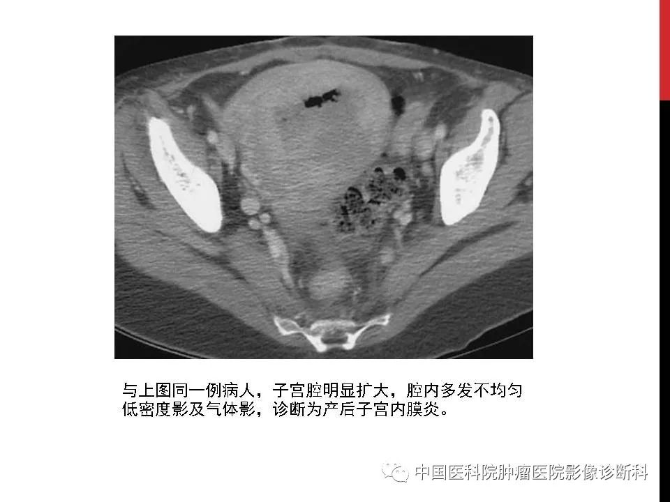 影像PPT - 【PPT】妇产科急腹症的影像诊断-39 影像PPT - 【PPT】妇产科急腹症的影像诊断-39