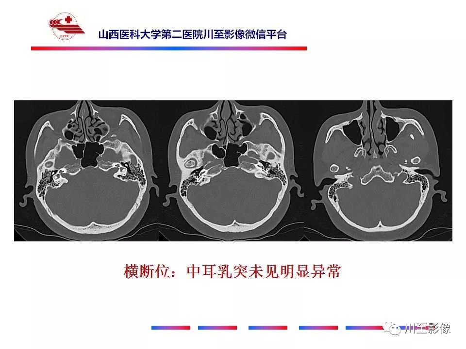 影像PPT - 【病例】上半规管裂综合征2例CT影像-3 影像PPT - 【病例】上半规管裂综合征2例CT影像-3