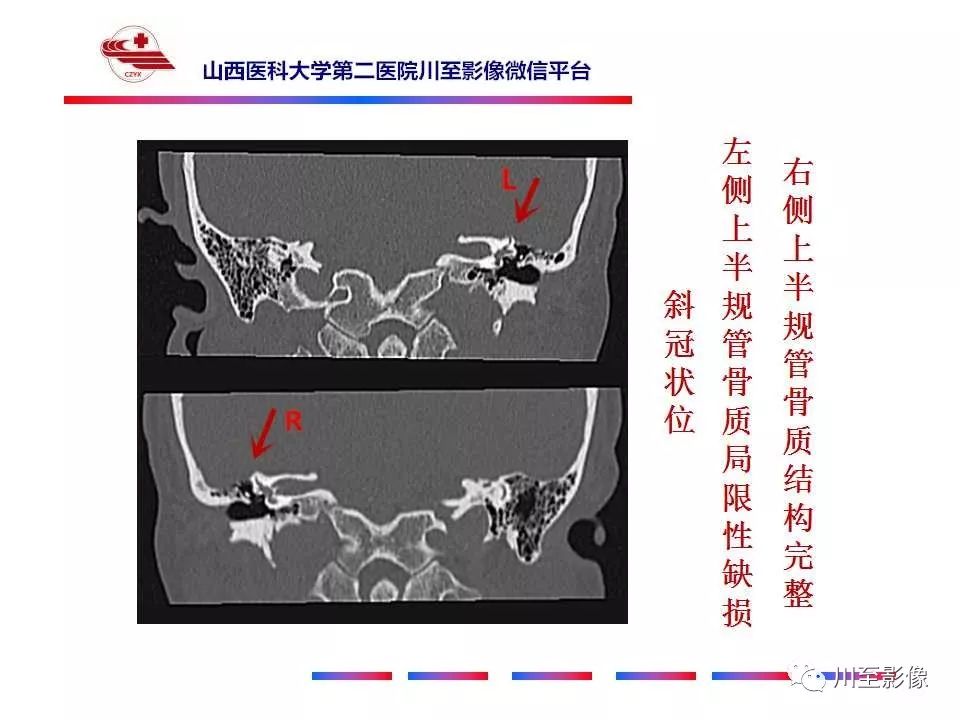 影像PPT - 【病例】上半规管裂综合征2例CT影像-4 影像PPT - 【病例】上半规管裂综合征2例CT影像-4