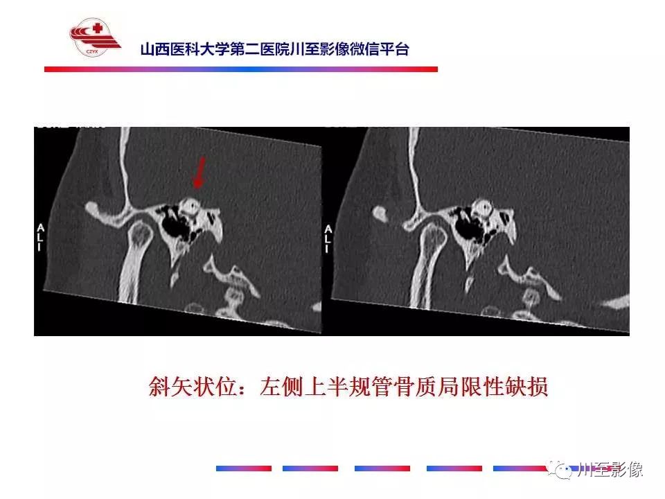 影像PPT - 【病例】上半规管裂综合征2例CT影像-5 影像PPT - 【病例】上半规管裂综合征2例CT影像-5