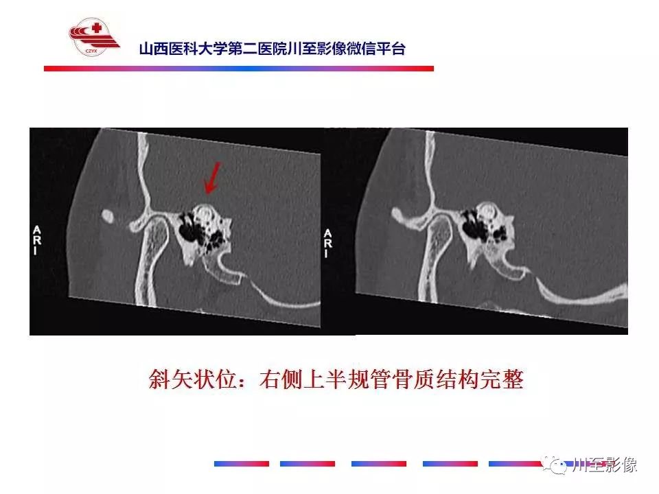 影像PPT - 【病例】上半规管裂综合征2例CT影像-6 影像PPT - 【病例】上半规管裂综合征2例CT影像-6