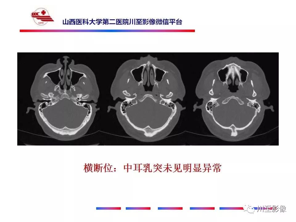 影像PPT - 【病例】上半规管裂综合征2例CT影像-8 影像PPT - 【病例】上半规管裂综合征2例CT影像-8