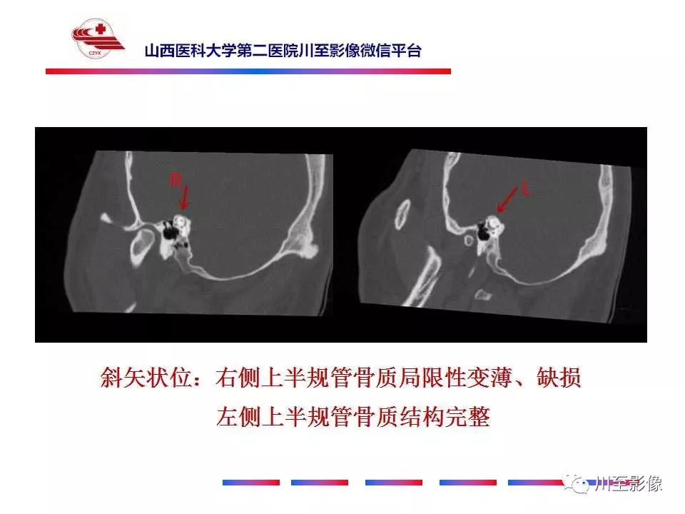 影像PPT - 【病例】上半规管裂综合征2例CT影像-9 影像PPT - 【病例】上半规管裂综合征2例CT影像-9
