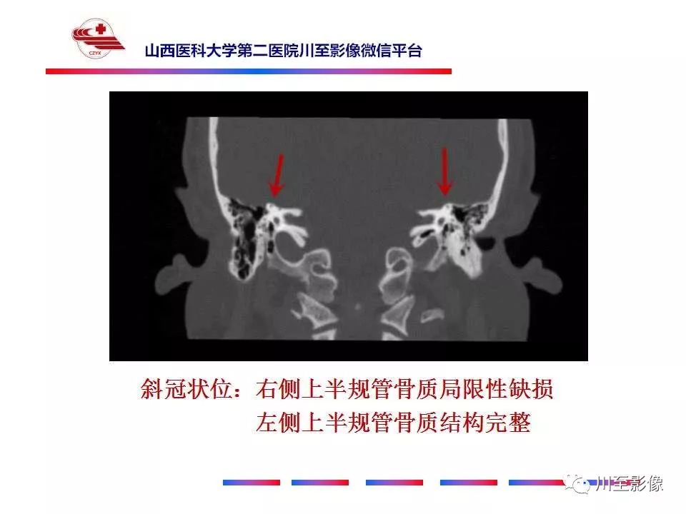 影像PPT - 【病例】上半规管裂综合征2例CT影像-10 影像PPT - 【病例】上半规管裂综合征2例CT影像-10
