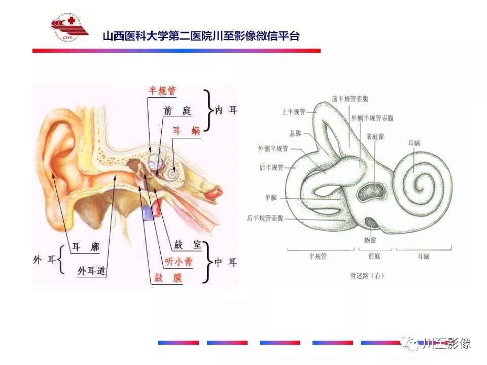 影像PPT - 【病例】上半规管裂综合征2例CT影像-13 影像PPT - 【病例】上半规管裂综合征2例CT影像-13