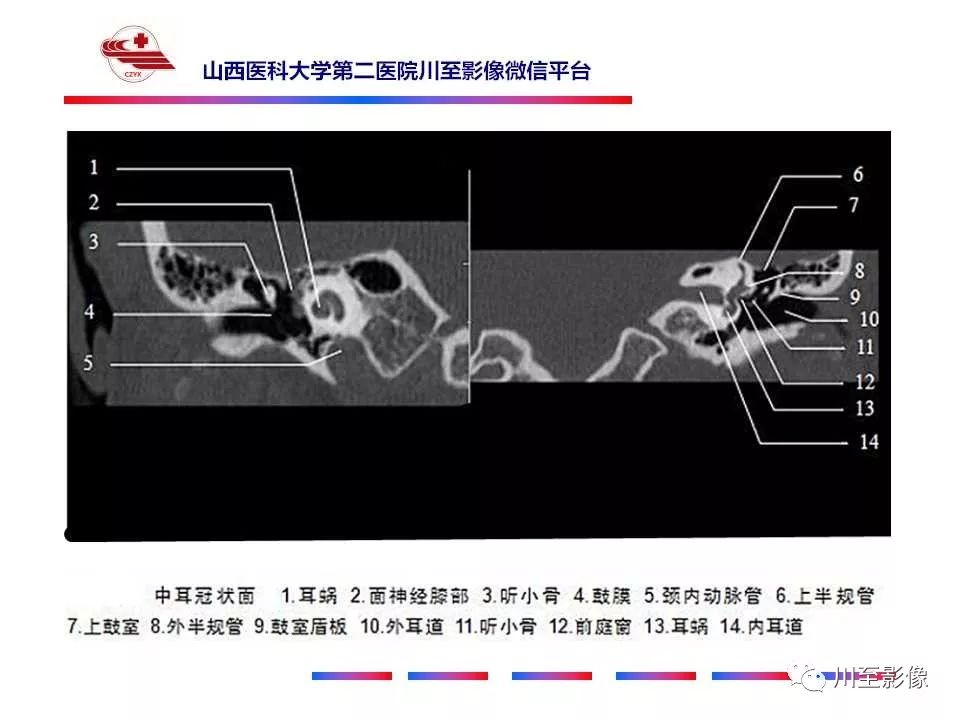影像PPT - 【病例】上半规管裂综合征2例CT影像-14 影像PPT - 【病例】上半规管裂综合征2例CT影像-14