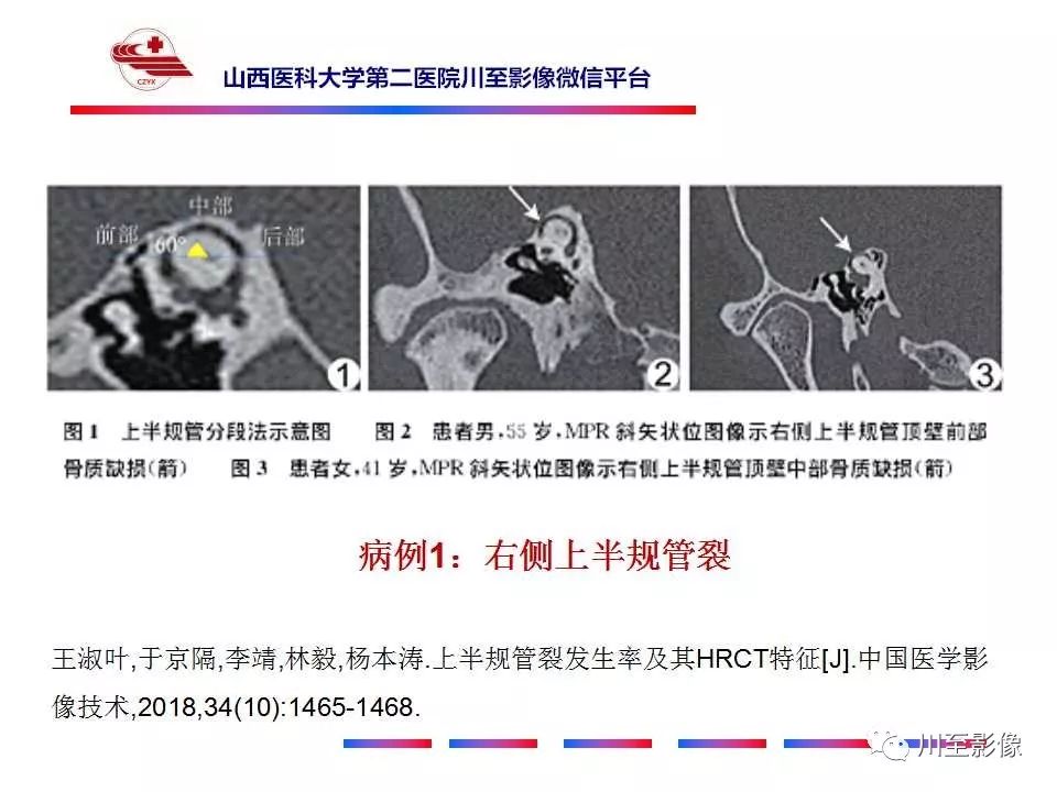 影像PPT - 【病例】上半规管裂综合征2例CT影像-23 影像PPT - 【病例】上半规管裂综合征2例CT影像-23