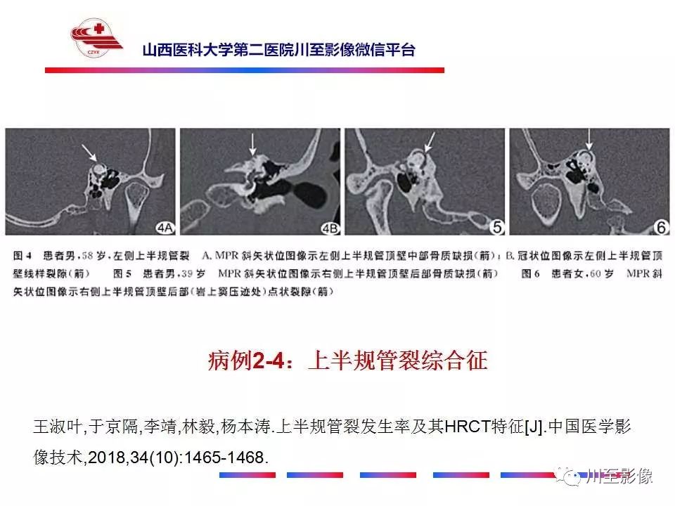 影像PPT - 【病例】上半规管裂综合征2例CT影像-24 影像PPT - 【病例】上半规管裂综合征2例CT影像-24