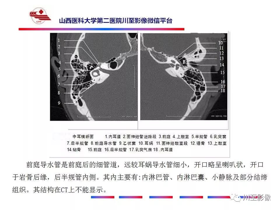 影像PPT - 【病例】上半规管裂综合征2例CT影像-28 影像PPT - 【病例】上半规管裂综合征2例CT影像-28