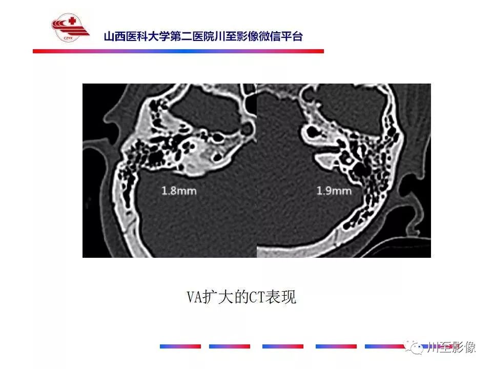 影像PPT - 【病例】上半规管裂综合征2例CT影像-30 影像PPT - 【病例】上半规管裂综合征2例CT影像-30